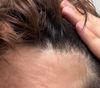 21M with Receding Hairline Using Finasteride &amp; Minoxidil: Should I Start Oral Minoxidil?