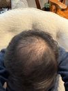 Considering Switch to Oral Finasteride 1mg &amp; Minoxidil 3mg/Day: Seeking Advice on Efficacy and Side Effects