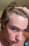 27M on Finasteride/Minoxidil 8-9 Months, Considering Dutasteride for Hair Loss