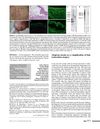 Alopecia Areata as a Complication of Hair Restoration Surgery