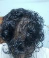 7 Months on Fin + Min + 1 Month Microneedling