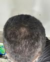 17M Noticing Rapid Hair Loss in 2 Weeks, Advice Needed