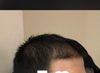 My hair has been thin since I was a kid - is a transplant the only way?