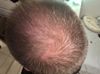 25M: Regrowth Chances After 5 Years on Minoxidil Alone Now Adding Finasteride and Others?