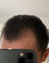 Hair loss through the middle of my head 2 years on finasteride and 9 months post HT