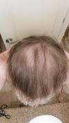 After 7 Months on Oral Finasteride and Minoxidil 5%: Unsure of Results, Seeking Advice