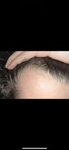 Seeing tiny black hairs after using topical minoxidil