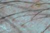 Seeking Analysis: Receded Temple Closeups for Scarring or AGA Signs