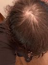 On Creatine and Minoxodil for 1 week, quick shedding or progressing MPB