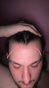 22M Seeking Advice on Hairline Recession; Stopped Finasteride Due to Side Effects