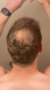 Is it time for a Hair Transplant based on the thinning/balding in my crown
