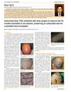 How I Do It: Untouched Strip: FUE Combined With Strip Surgery To Improve The Follicular Unit Number Harvested In One Session, Preserving An Untouched Area For A Possible Future Transplant
