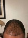 22M, 5 Months on Hims Min+Fin Spray, Considering Dut+Topical Minox for Thinning