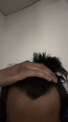 Am I balding I’m 18 and worried pls help