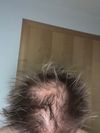 Hair Loss After 15kg Weight Loss, Fin+Microneedling for 2.5 Months, Seeking Advice