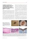 Lentiginous Melanoma: A Clinically Malignant Entity That Histopathologically Seems Benign. Case Study Harboring BRAF V600R Mutation