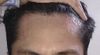 M31. Should i continue with min + tretinoin or i should go for a HT on the temples?