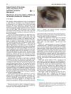 Hypertrichosis of the Malar Areas and Poliosis of the Eyelashes Caused by Latanoprost