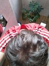 15-Year-Old Seeking Tips to Prevent Hair Loss; Norwood Level 2?
