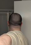 After 5 Months of HIMS Topical Fin + Min: Back of Head Stalled, Seeking Advice on Growing Out