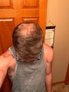 Advice Needed: Considering Switch from Topical to Oral Finasteride After 2 Years (July 2023)