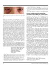Severe Steroid-Dependent Idiopathic Angioedema with Response to Rituximab