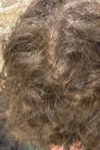 20M Struggling with Crown Thinning, Considering Finasteride and Shaving Head