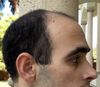 1.5 months into finasteride. 25M. Will start Minoxidil at the 2 month part, as well as ket shampoo