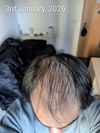 21M (&lsquo;05) - Monthly Progress Journal (Since Jan 2, 2026) | Oral Fin/Min + Scalp Optimization