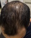 Hair loss stable for 8+ years – is it still possible to regrow, or should I just accept it?
