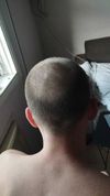 Worth starting treatment at this point?
