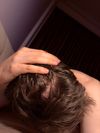 19M Using Min for 3 Months, Topical Fin for 2 Months - What Type of Balding?