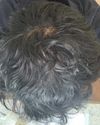 Straightforward: 	•	21M – 7 months on minoxidil, hair looks worse