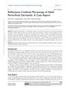 Reflectance Confocal Microscopy of Adult Periorificial Dermatitis: A Case Report
