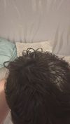 20-Year-Old Seeking Opinions on High Hairline and Recession