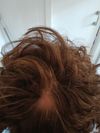 Sudden Triangular Thinning Patch
