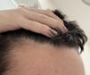 Concerned About Increased Hair Loss After 2 Months on Finasteride - Should I Stop?