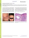 Disseminated Small Papules on the Face: A Quiz