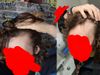 Increased Hairline Recession After 1 Month on Oral Finasteride 1mg and Minoxidil 2.5mg: Normal? Solutions?