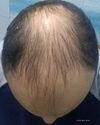 30-Year-Old Starting Finasteride with Minoxidil: Can I Still Regrow Hair?