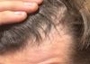 Finasteride or Microneedling?