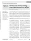 Dermoscopy: Distinguishing Malignant Tumors From Benign
