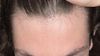 19M, 2 Months on Minoxidil - Severe Shedding, What Regrowth to Expect?