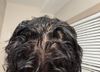 Struggling with Chronic Hair Loss Despite Treatments at 20