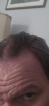 I need to advice on if microneedling with pen will help a norwood 2.5-3 frontal loss