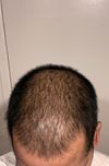 First time rapid shedding M(30) in last 6-7 months. What to do?