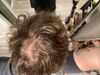 M33: Is My Cowlick Actually Diffuse Thinning Despite Minoxidil?