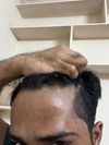 Male, 1 Year on Topical Minoxidil - Assessing Progress with Photos