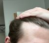Male, 5 Years of Recession, Starting Oral Minoxidil &amp; Microneedling - Advice Needed