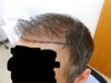 Concerns About Hair Gaps After 4150 Graft FUE and Dutasteride/Minoxidil Use